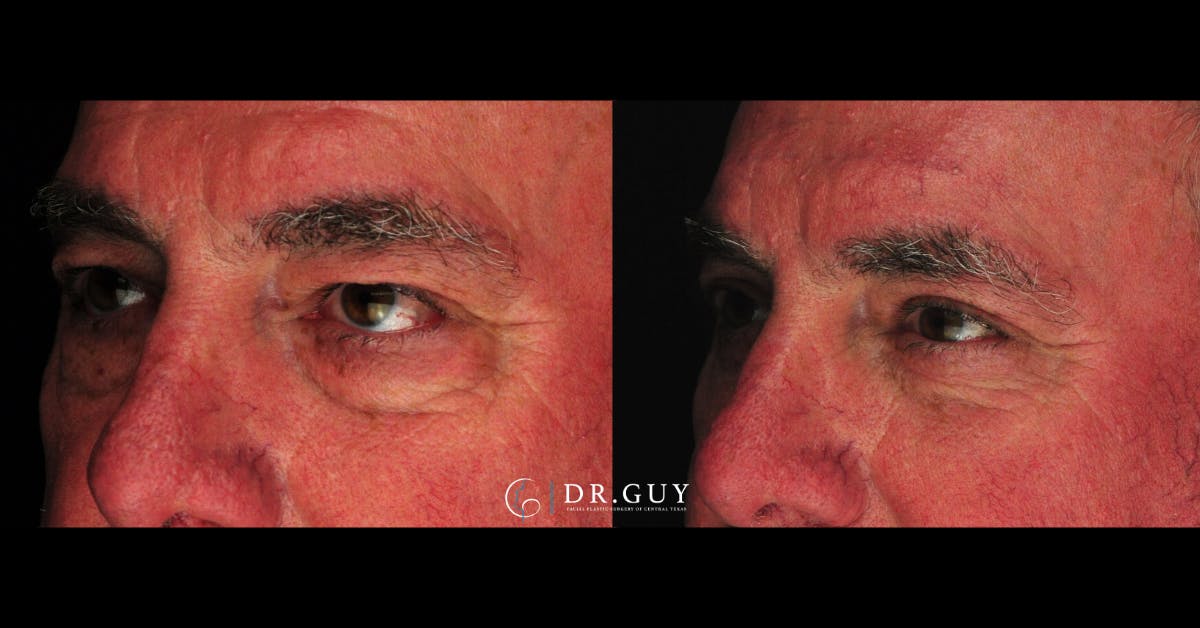 Lower Blepharoplasty Before & After Gallery - Patient 202920 - Image 1