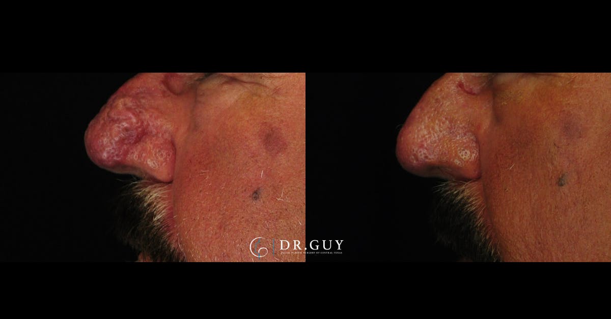 Rhinophyma Before & After Gallery - Patient 275582 - Image 3