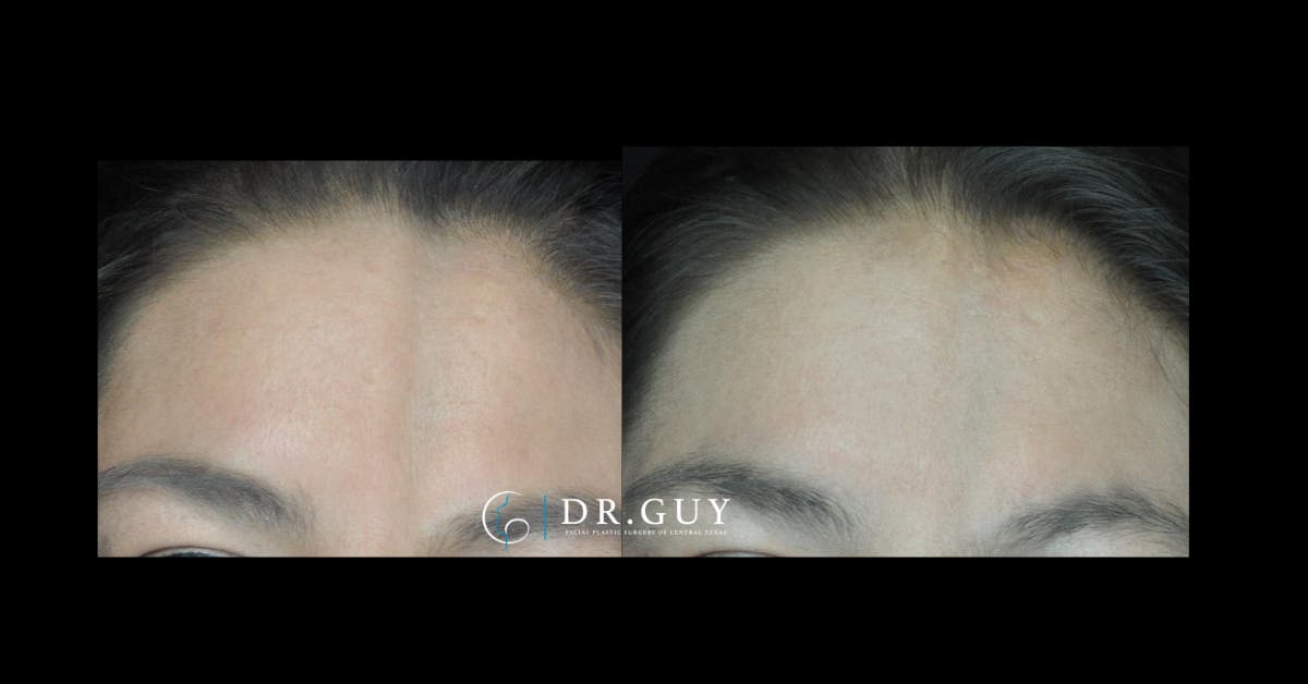 Fat Grafting Before & After Gallery - Patient 396504 - Image 3