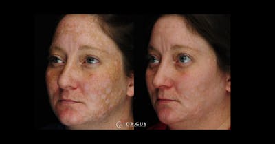 Chemical Peels Before & After Gallery - Patient 185614 - Image 1