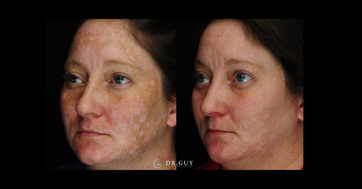 Chemical Peels Before & After Gallery - Patient 185614 - Image 1