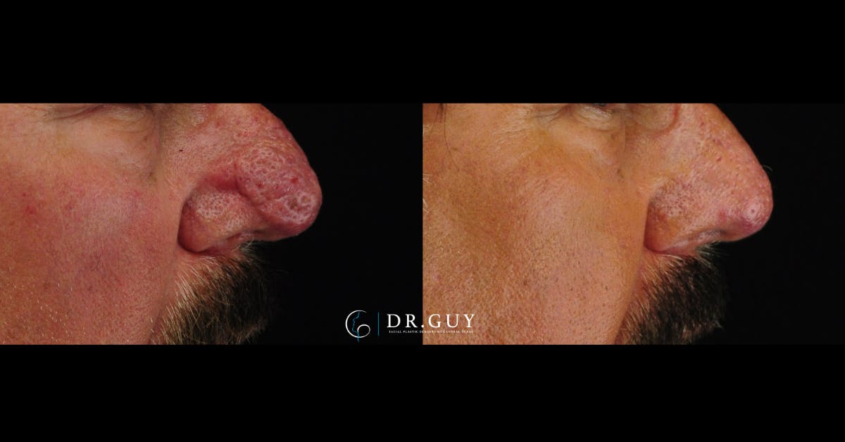 Rhinophyma Before & After Gallery - Patient 275582 - Image 4