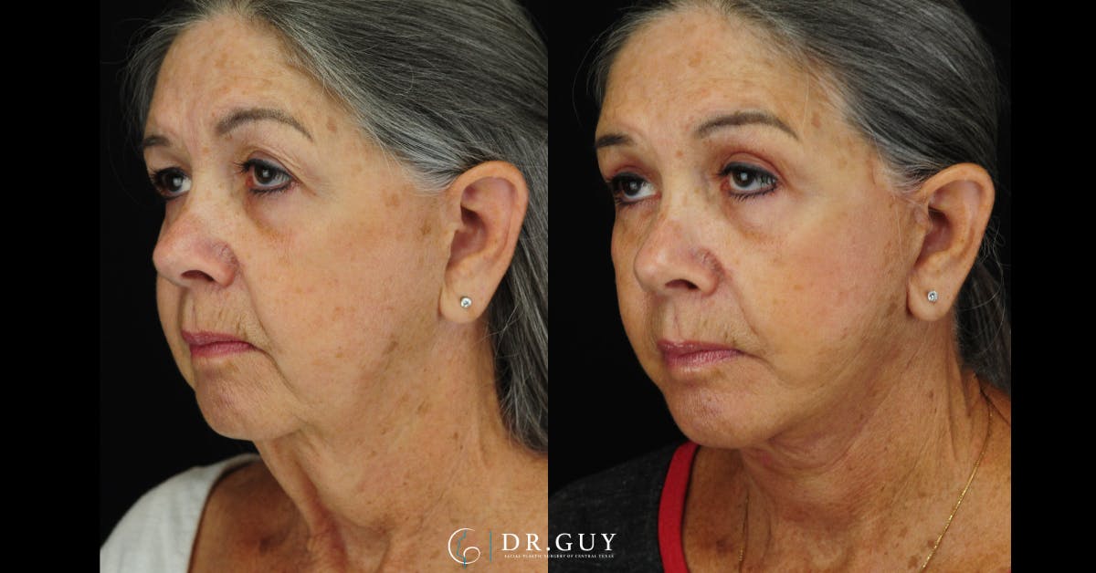Upper Blepharoplasty Before & After Gallery - Patient 411047 - Image 3