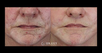 Fat Grafting Before & After Gallery - Patient 415409 - Image 1