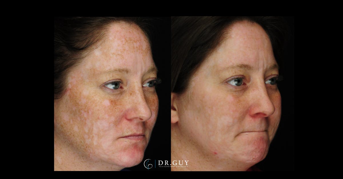 Chemical Peels Before & After Gallery - Patient 185614 - Image 2