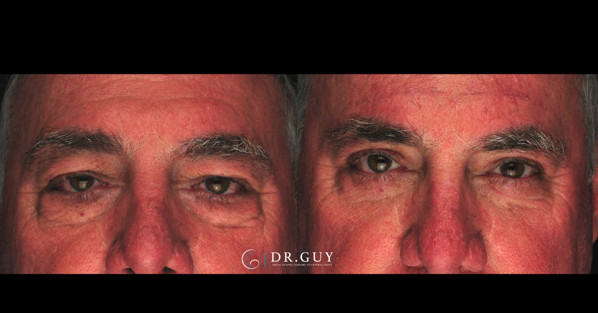 Lower Blepharoplasty Before & After Gallery - Patient 202920 - Image 3