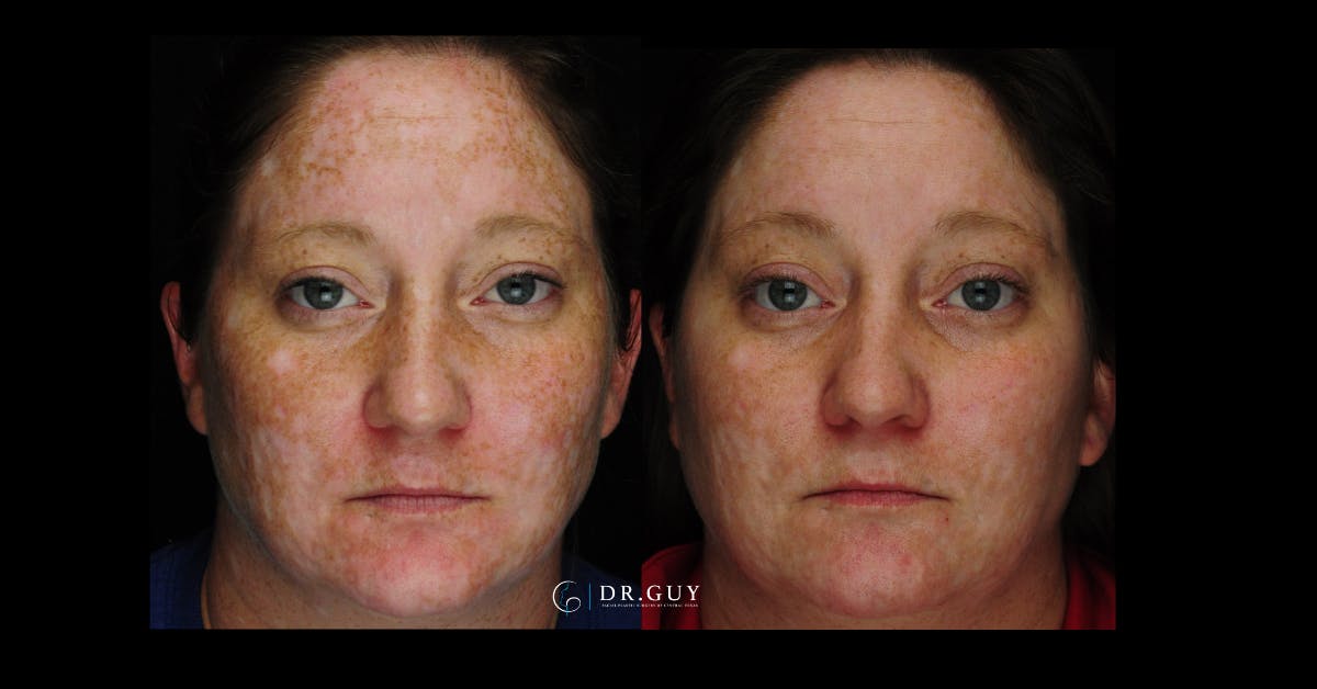 Chemical Peels Before & After Gallery - Patient 185614 - Image 3