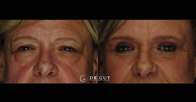 Fat Grafting Before & After Gallery - Patient 102772 - Image 1