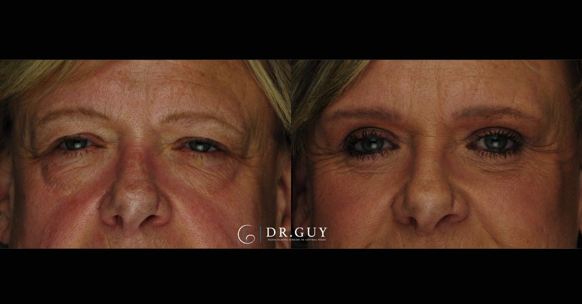 Fat Grafting Before & After Gallery - Patient 102772 - Image 1