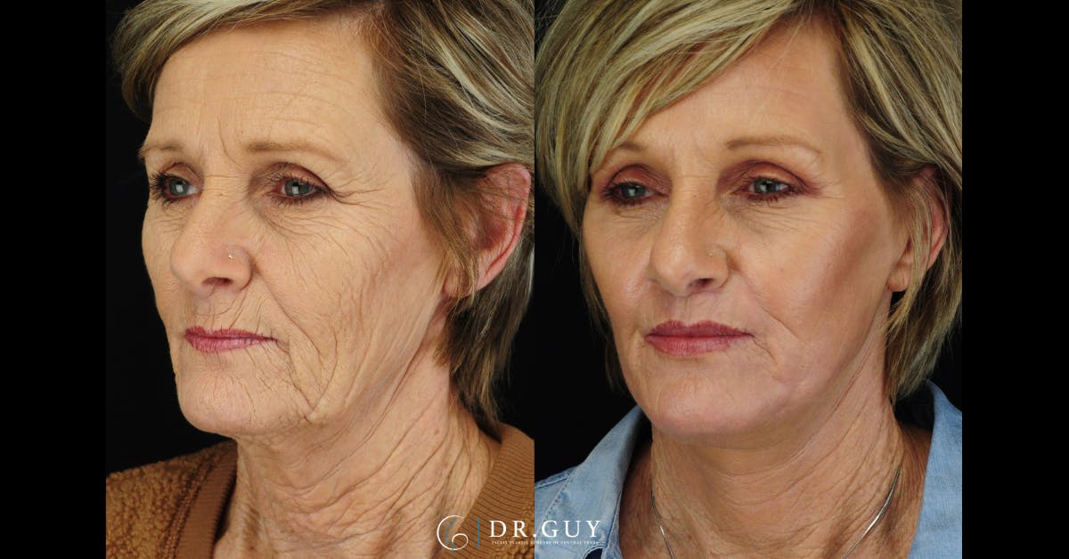 Laser Before & After Gallery - Patient 338458 - Image 1