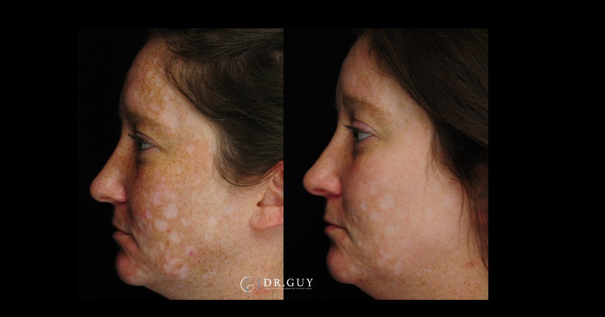 Chemical Peels Before & After Gallery - Patient 185614 - Image 4