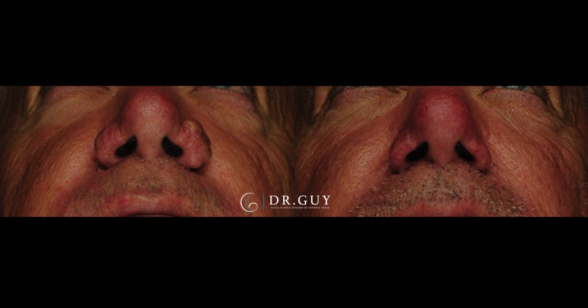 Rhinophyma Before & After Gallery - Patient 279264 - Image 2