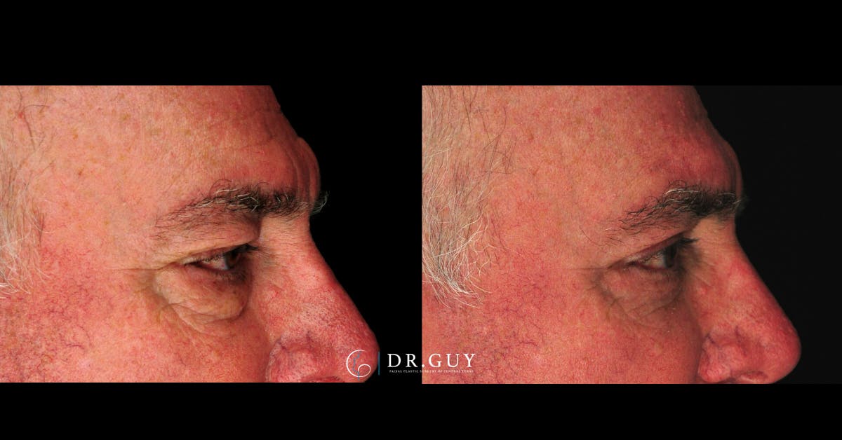 Lower Blepharoplasty Before & After Gallery - Patient 202920 - Image 5