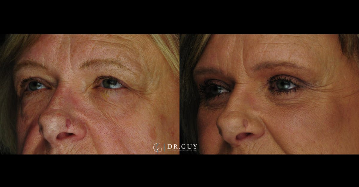 Fat Grafting Before & After Gallery - Patient 102772 - Image 2