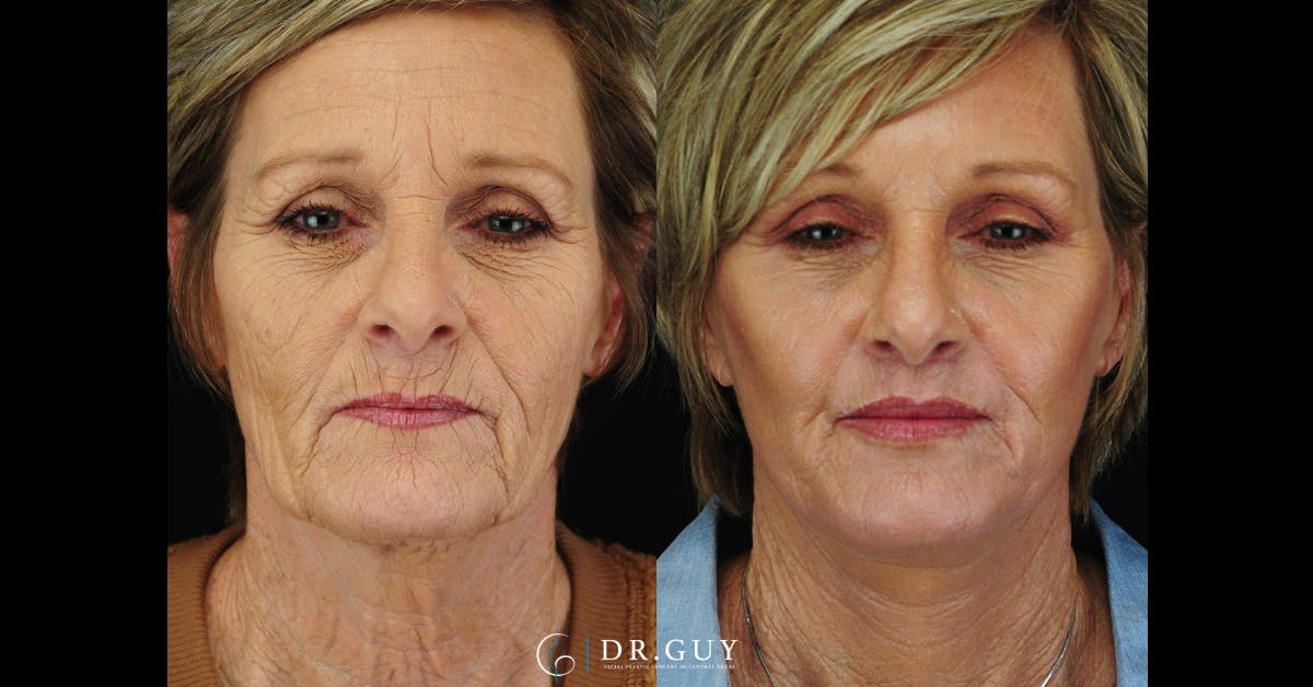 Laser Before & After Gallery - Patient 338458 - Image 2
