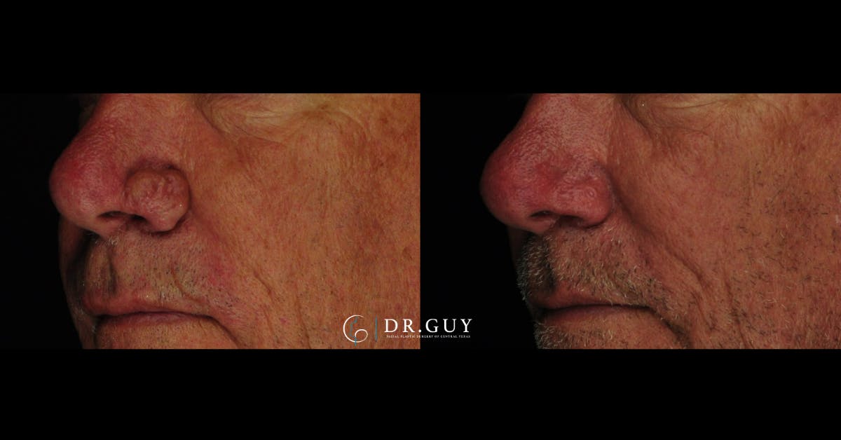 Rhinophyma Before & After Gallery - Patient 279264 - Image 3