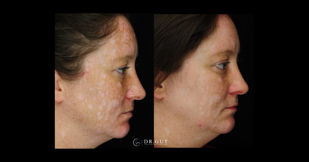 Chemical Peels Before & After Gallery - Patient 185614 - Image 5