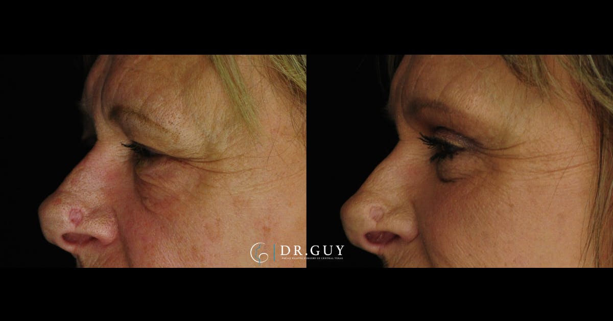 Fat Grafting Before & After Gallery - Patient 102772 - Image 3