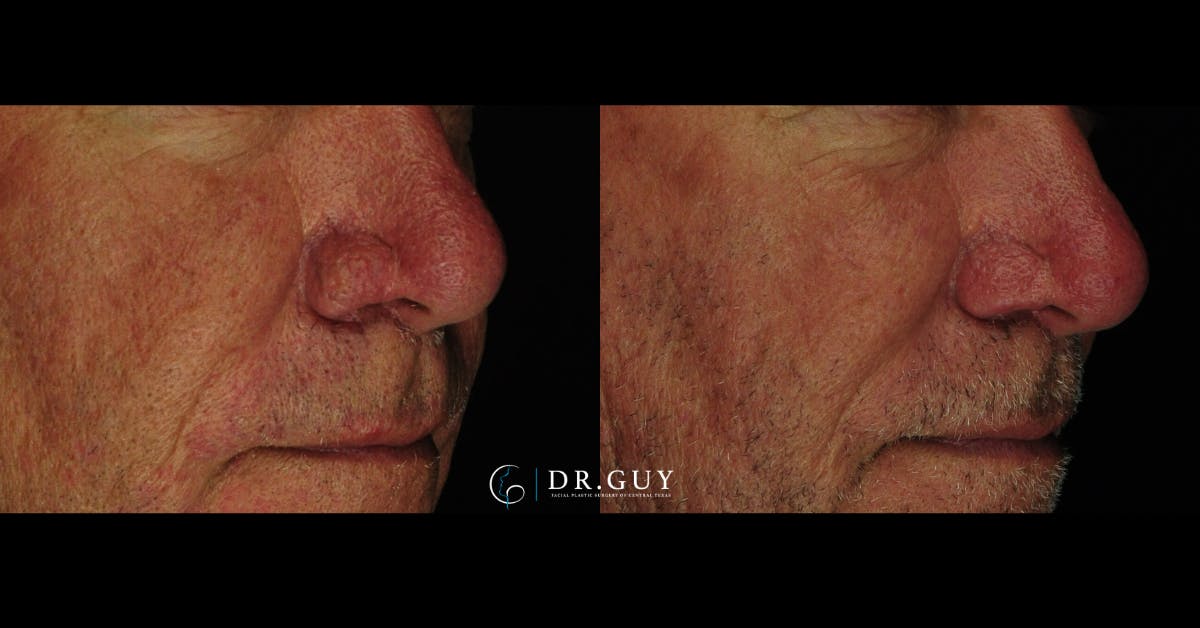 Rhinophyma Before & After Gallery - Patient 279264 - Image 4