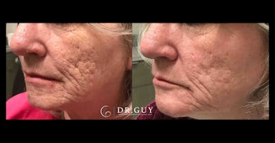 Scar Revision Before & After Gallery - Patient 391100 - Image 1