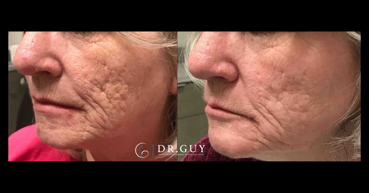 Scar Revision Before & After Gallery - Patient 391100 - Image 1