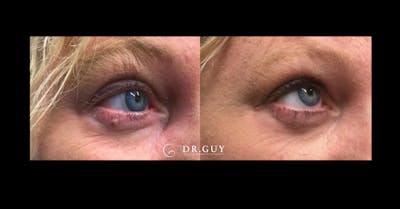 Mole Removal Before & After Gallery - Patient 391436 - Image 1