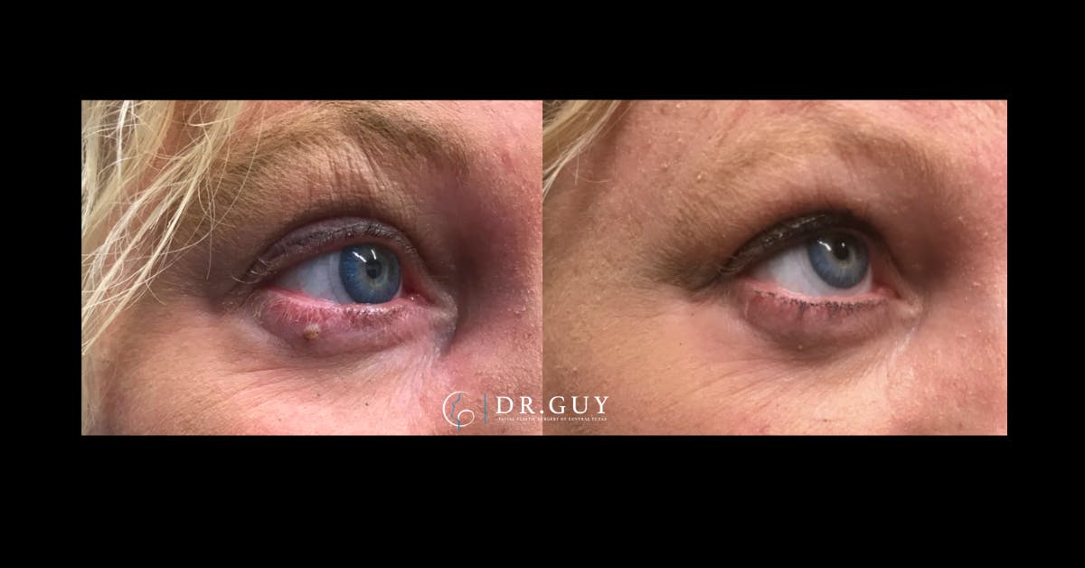 Mole Removal Before & After Gallery - Patient 391436 - Image 1