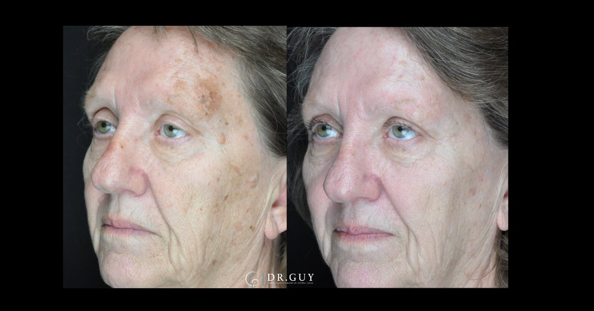 Chemical Peels Before & After Gallery - Patient 132804 - Image 1