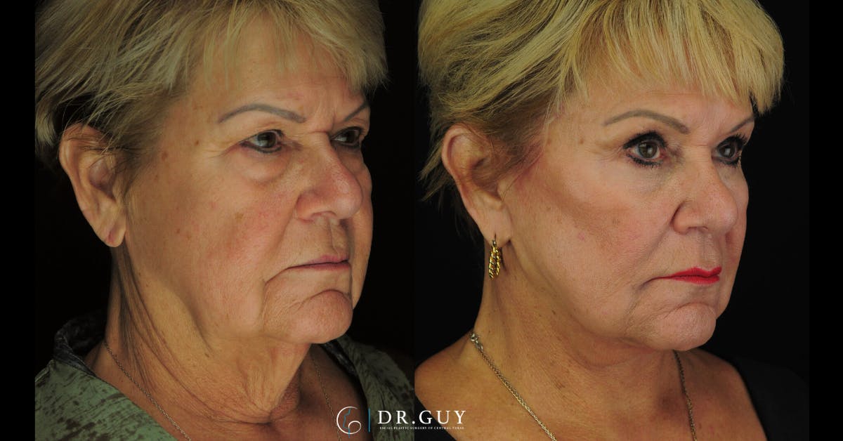 Upper Blepharoplasty Before & After Gallery - Patient 179621 - Image 4