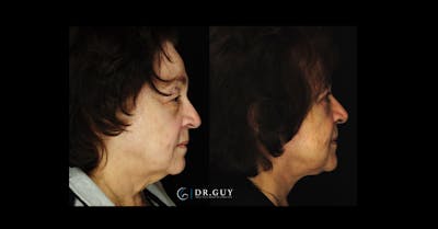 Fat Grafting Before & After Gallery - Patient 142198 - Image 1
