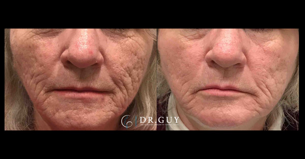 Scar Revision Before & After Gallery - Patient 391100 - Image 2