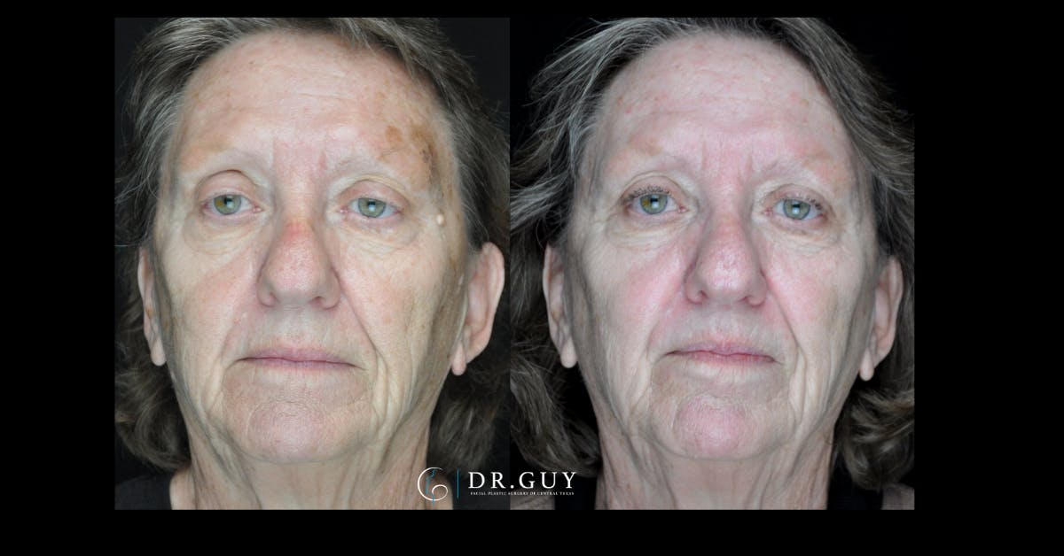 Chemical Peels Before & After Gallery - Patient 132804 - Image 2