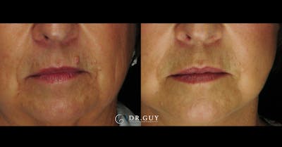 Mole Removal Before & After Gallery - Patient 183224 - Image 1