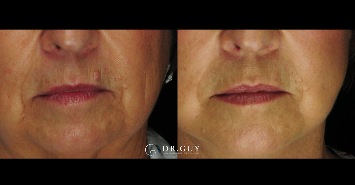 Mole Removal Before & After Gallery - Patient 183224 - Image 1