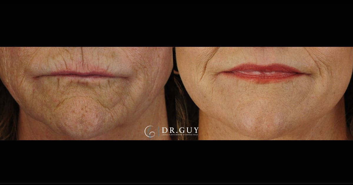 Laser Before & After Gallery - Patient 828422 - Image 1