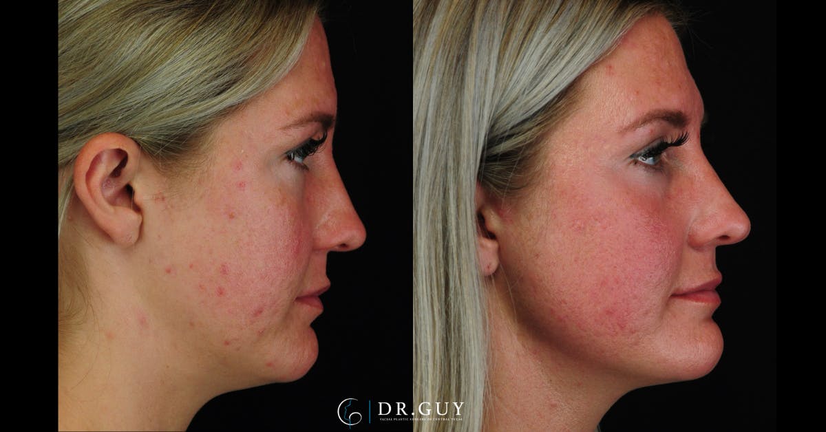 Morpheus8 Before & After Gallery - Patient 387466 - Image 1