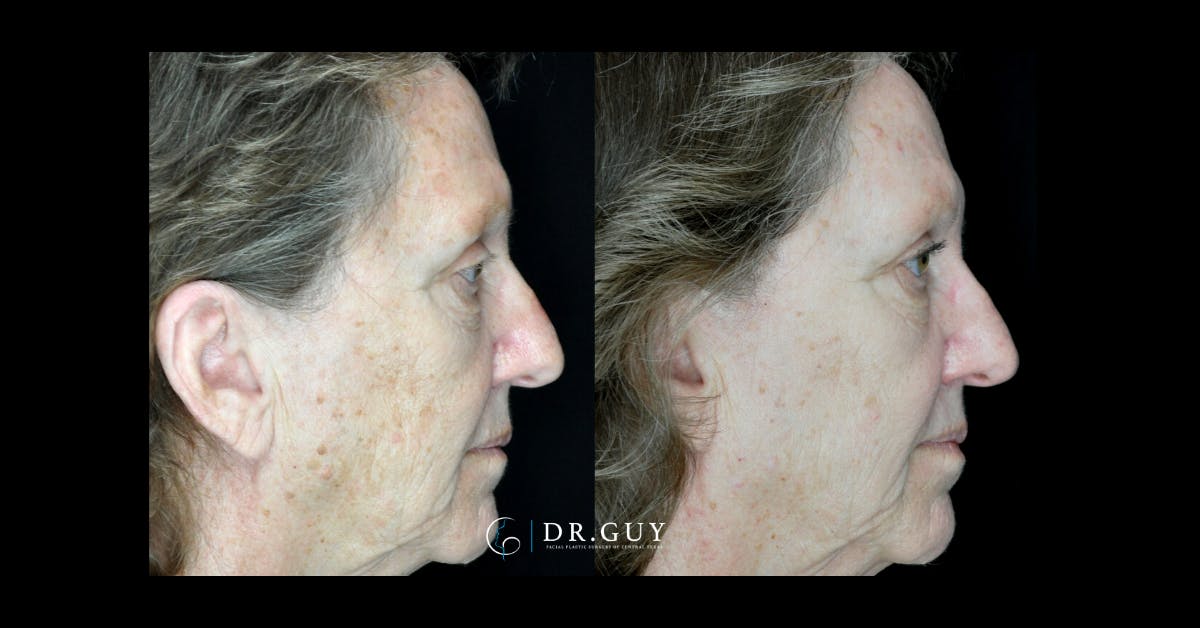 Chemical Peels Before & After Gallery - Patient 132804 - Image 3