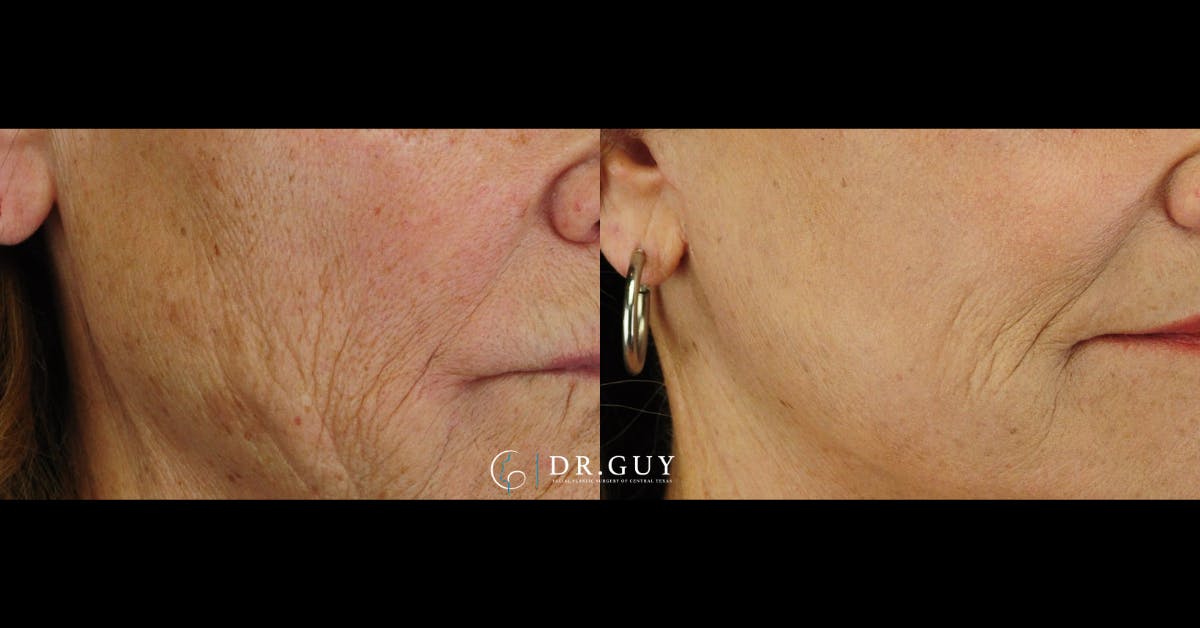 Laser Before & After Gallery - Patient 828422 - Image 2