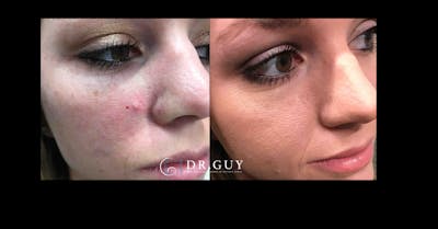 Mole Removal Before & After Gallery - Patient 427215 - Image 1