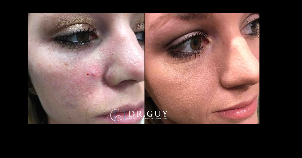Mole Removal Before & After Gallery - Patient 427215 - Image 1