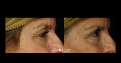 Upper Blepharoplasty Before & After Gallery - Patient 235735 - Image 1