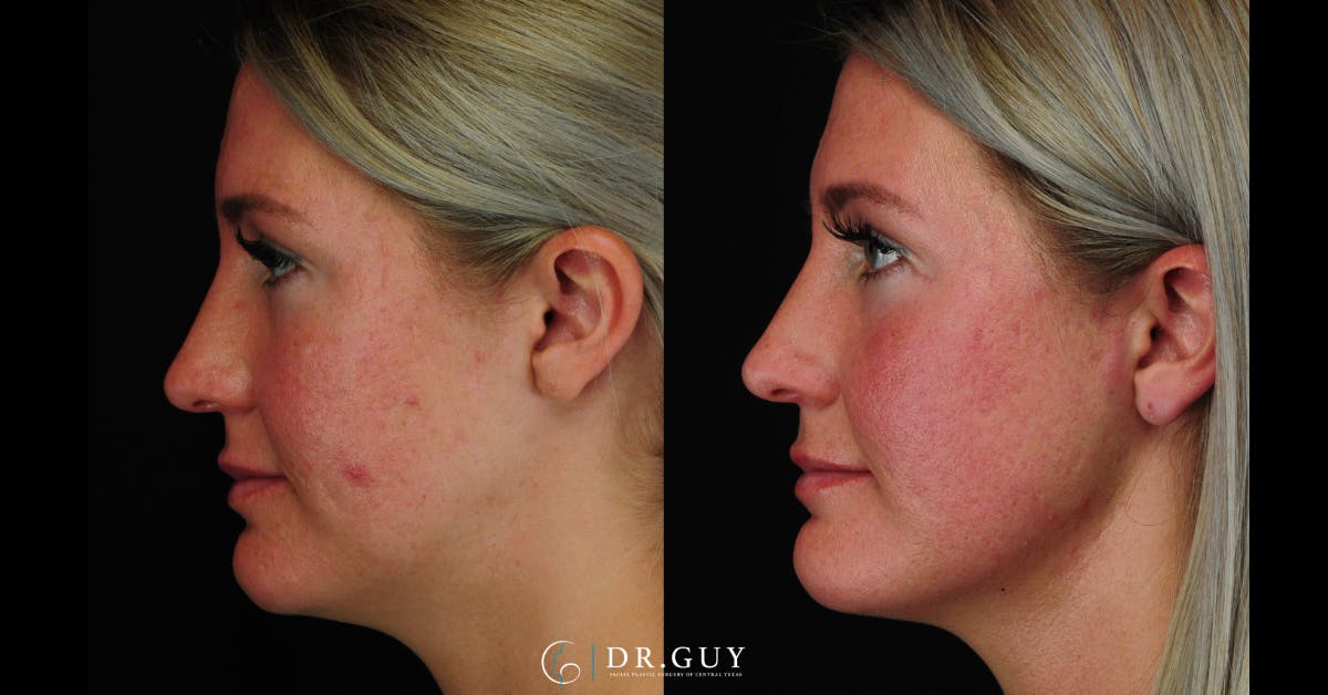 Morpheus8 Before & After Gallery - Patient 387466 - Image 2