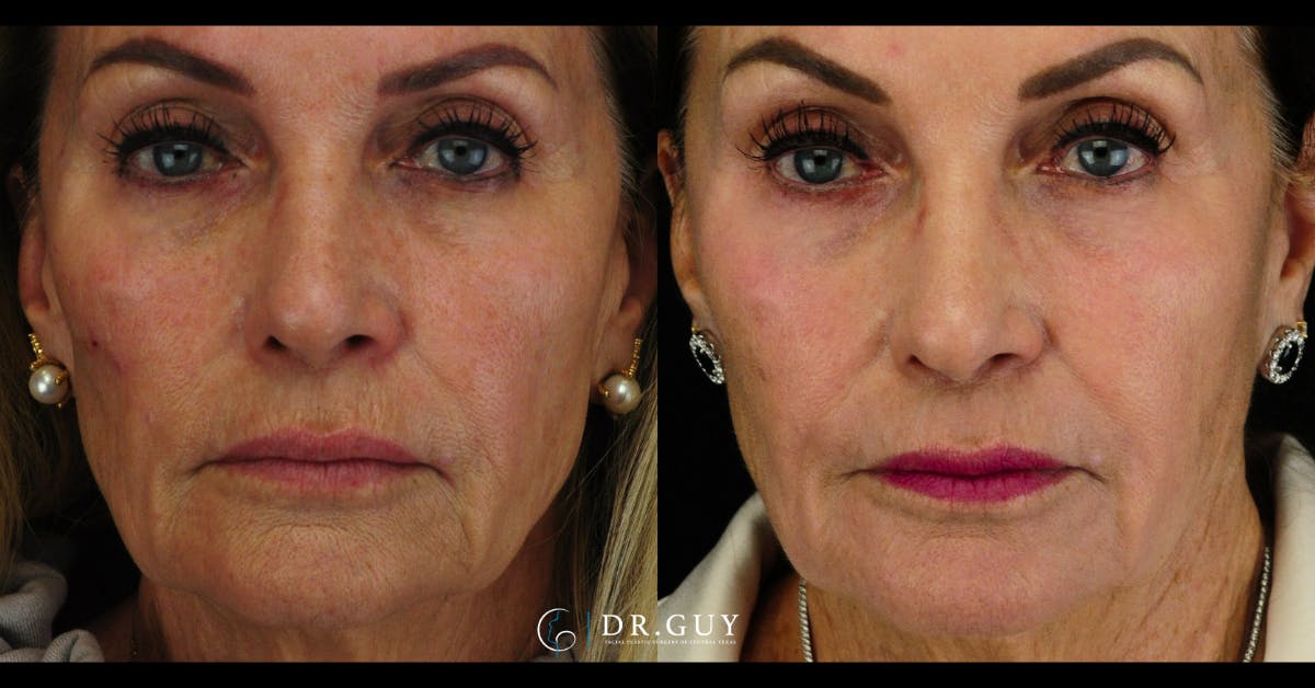 Laser Before & After Gallery - Patient 689786 - Image 1