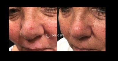 Mole Removal Before & After Gallery - Patient 294981 - Image 1