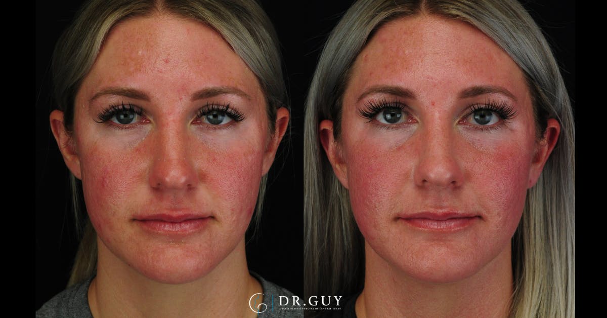 Morpheus8 Before & After Gallery - Patient 387466 - Image 3