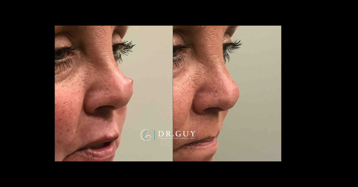 Mole Removal Before & After Gallery - Patient 294981 - Image 2
