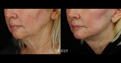 Laser Before & After Gallery - Patient 180288 - Image 1