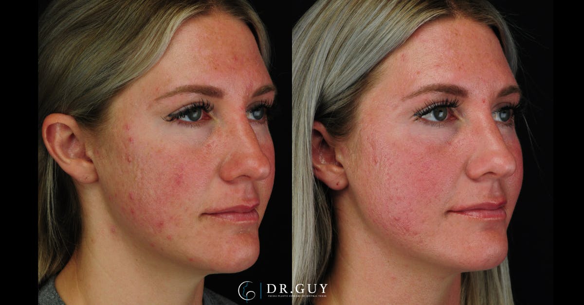 Morpheus8 Before & After Gallery - Patient 387466 - Image 4