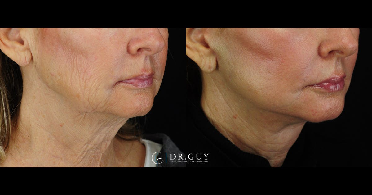 Laser Before & After Gallery - Patient 180288 - Image 2