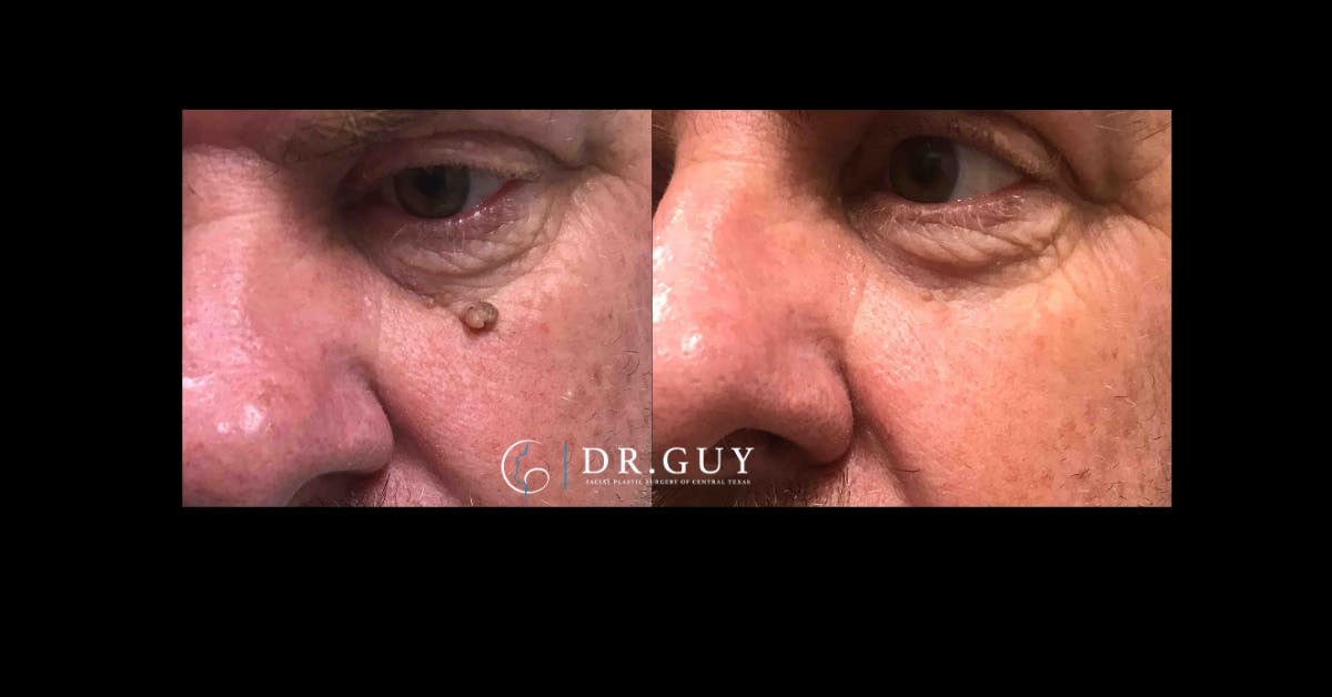 Mole Removal Before & After Gallery - Patient 489693 - Image 1